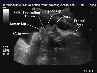 Macroglossia