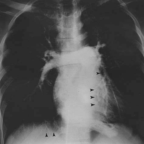 A. Bronchogram showing cylindrical bronchiectasis of the left lower... | Download Scientific Diagram