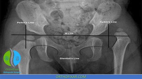 Ortolani Test For DDH Overview | OrthoFixar 2024