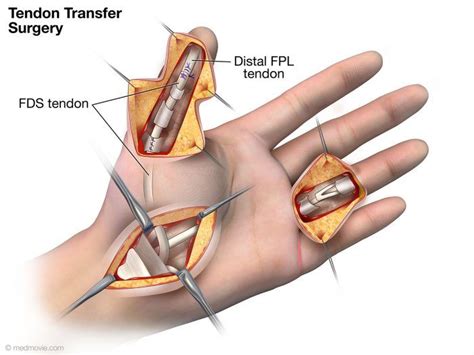 Tendon Rupture Following Trigger Finger Release | Trigger finger ...