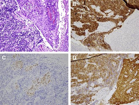 HPV-positive oropharyngeal carcinoma shows both small cell and squamous... | Download Scientific ...