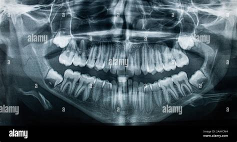 x-ray jaw front view ,concept medical , health care Stock Photo - Alamy