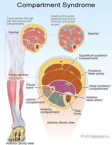 Compartment Syndrome - Podiatry First