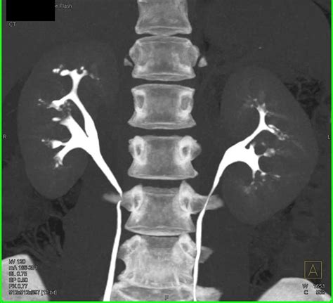 Papillary Necrosis Bilaterally / CTisus.com | Case study, Kidney, Study