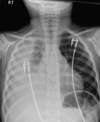 Empyema Drainage | Radiology Key