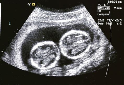 Smithback Twins: 16 Week Ultrasound Pictures!