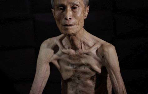 Nagasaki Bomb Survivor Shows Off The Scars Of Nuclear War | Others