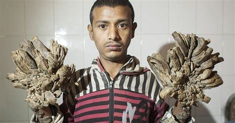 A guy born with Epidermodysplasia verruciformis (EV), also known as treeman syndrome. : r/Weird