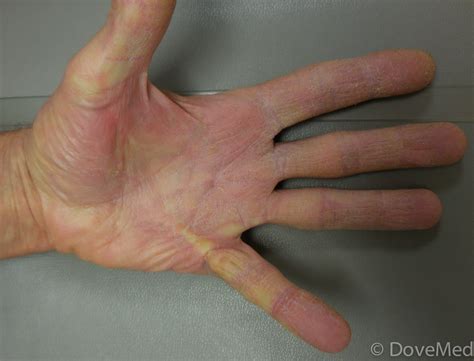 Dupuytren’s Contracture