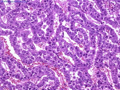 Webpathology.com: A Collection of Surgical Pathology Images