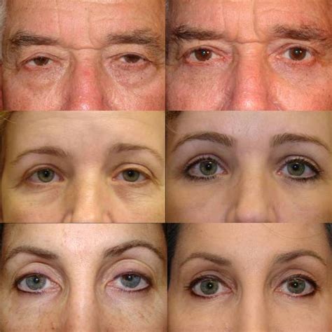 Ptosis Repair Surgery II - Cosmetic Eyelid Surgery in Beverly Hills - Dr. Guy MassryCosmetic ...