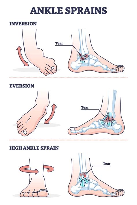 Ankle Sprains Situations With Inversion And Eversion Injury Outl - NTFANTFA