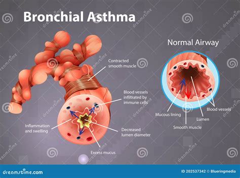 Bronchial Asthma