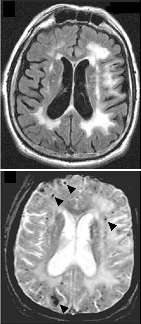 Leukoaraiosis | Practical Neurology