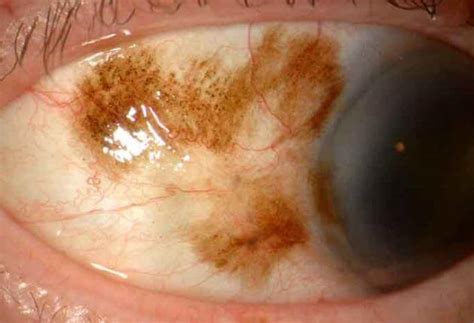 Conjunctival Primary Acquired Melanosis | Wills Eye Hospital