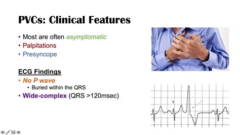 Premature Ventricular Contractions Causes