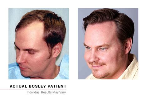 Hair Transplant Before/After Results for Men - Bosley Hair Transplant | Hair transplant, Hair ...