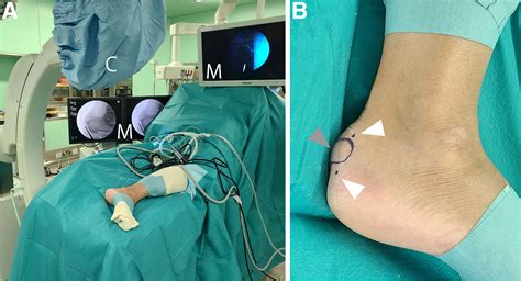 Fluoroscopic and Endoscopic Calcaneal Exostosis Resection and Achilles ...