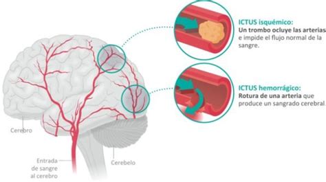 Cómo identificar el ictus | Tu canal de salud