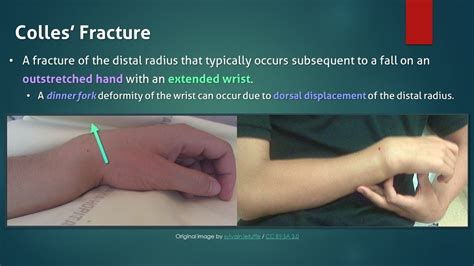 Colles Fracture Splint