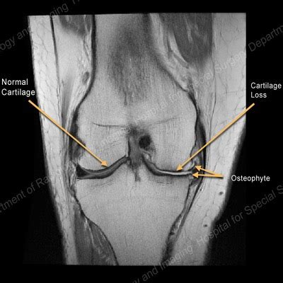 Knee Arthritis | Orthopedic Regenerative Medicine Center of Santa Rosa