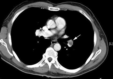 What is the sensitivity and specificity of CT?