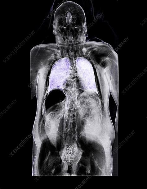 Trapped abdominal gas, CT scan - Stock Image - C025/6929 - Science Photo Library