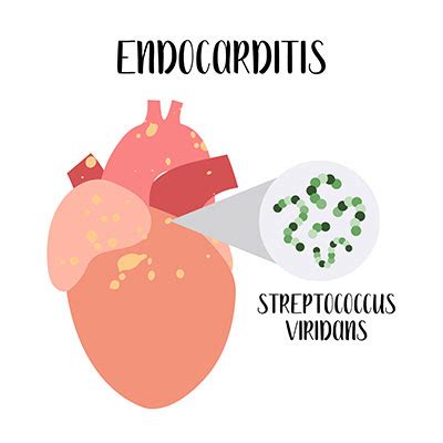 Streptococcus viridans (Viridans-Streptokokken) - Infektion, Übertragung & Krankheiten | MedLexi.de