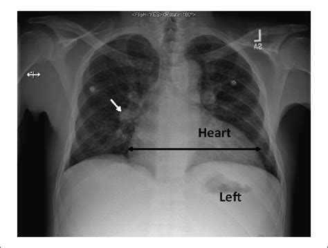 Posterioranterior chest radiograph revealing vascular congestion (short ...