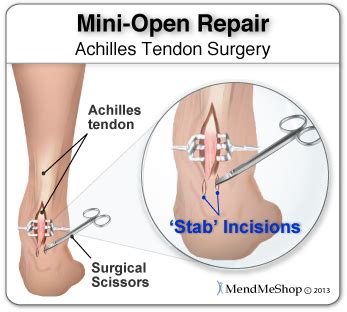 Post Surgery Rehabilitation - Achilles Tendonitis