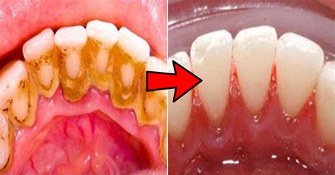 REMOVES PLAQUE AND WHITEN YOUR TEETH IN 15 MIN WITH THIS RECIPE THAT A DENTIST EVER YOU TELL ...