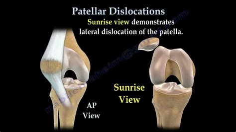 RECURRENT DISLOCATION PATELLA - DNB Orthopaedics MS Orthopedics MRCS Exam GUIDE - Orthodnb.com