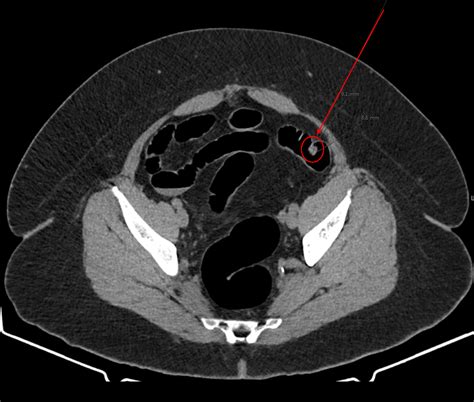 Colon Cancer Virtual Colonoscopy / Virtual Colonoscopy Detects Large Polyps Found With Visual ...