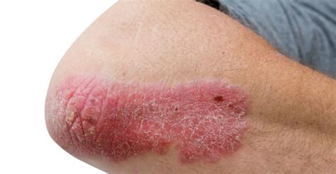 5 Types of Plaque Psoriasis and Their Treatment Options - The Frisky