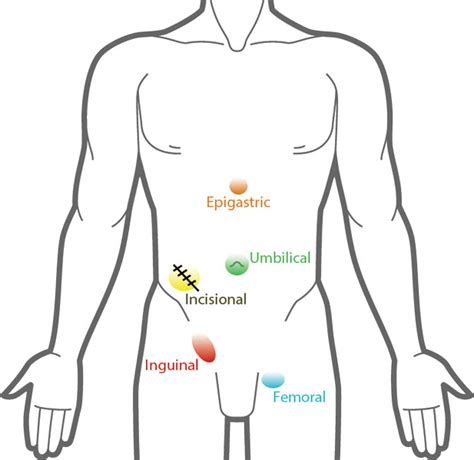 Hernias-General - MILE HIGH HERNIA INSTITUTE Rocky Mountain Surgical Assoc. Robert Macdonald, MD