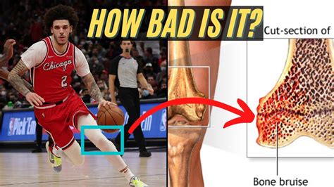 Expert Explains Lonzo Ball Injury (knee contusion) & timeline scenarios ...