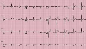 EKG vs. ECG: What’s the difference? - Cardiocare