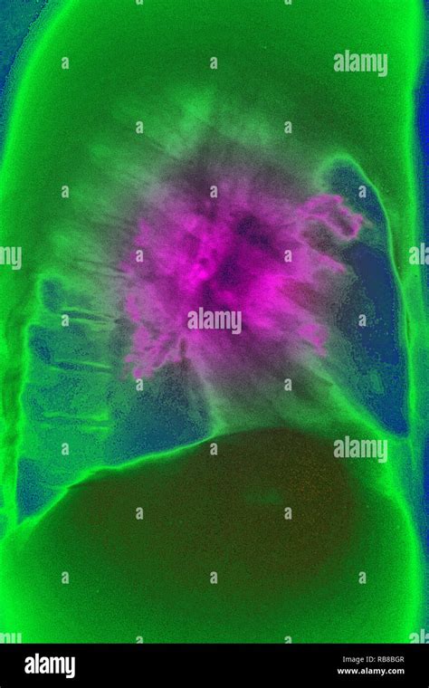 LUNG CANCER X-RAY Stock Photo - Alamy