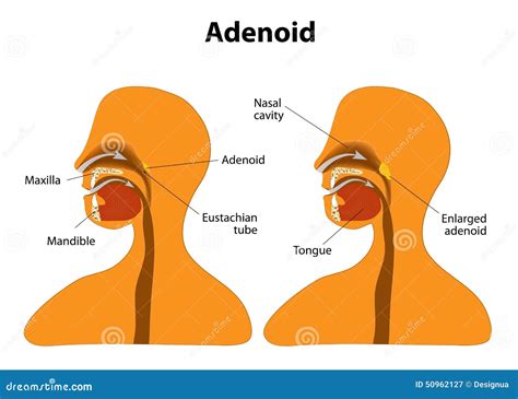 Adenoid. Normal And Enlarged Adenoid Stock Vector - Image: 50962127