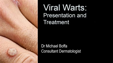 73 Images Of Viral Warts For FREE - MyWeb