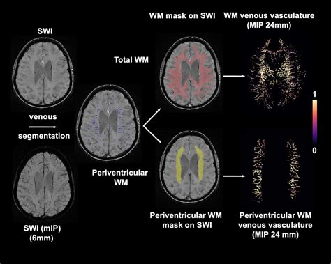 Frontiers | Reduced white matter venous density on MRI is associated with neurodegeneration and ...