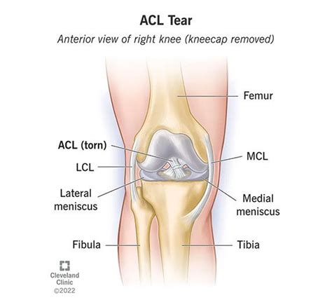 ACL Tear & Injury: Symptoms & Recovery | Acl tear, Acl, Acl knee