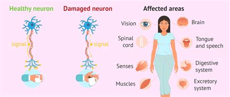 Consequences of multiple sclerosis