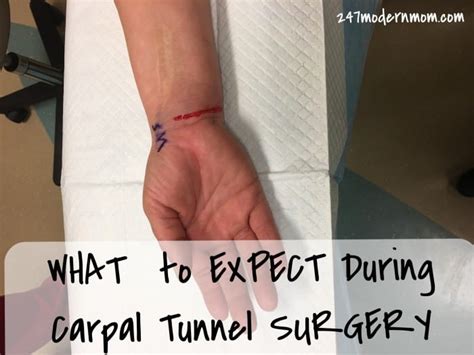 Carpal Tunnel Surgery: What to Expect During the Procedure