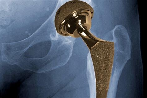 Iranian Researchers Produce Artificial Hip Joint - Iran Front Page