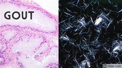 GOUT Under the Microscope: Brilliant Polarizable Birefringent Monosodium Urate Crystals - YouTube