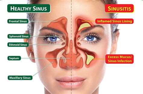 Sinus Headache - Causes, Symptoms, Relief & Treatment
