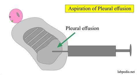 Fluid Analysis – part 6 – Pleural Fluid Analysis, Aspiration procedure, Thoracentesis – Labpedia.net