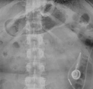 complication of lap Band Archives - DSSurgery