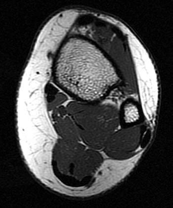 Foot Muscles Mri / MRI IN FOOT PAIN - tohtoha